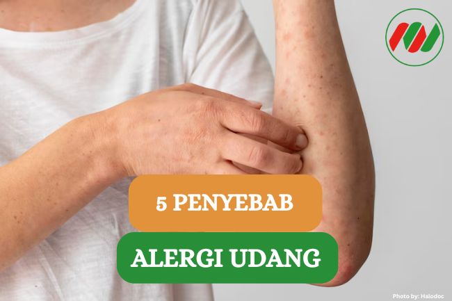 Inilah 5 Penyebab Munculnya Alergi Udang